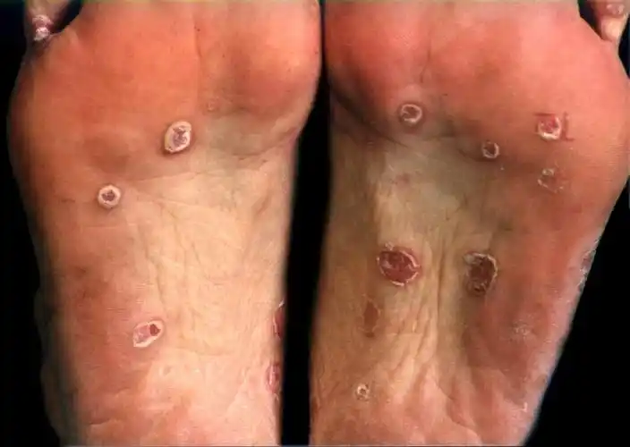 早期梅毒感染症状图图片