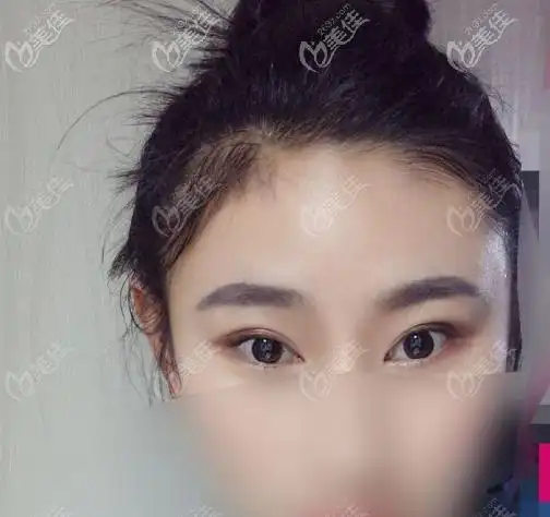 关于吊梢眼适合什么双眼皮和二次修复双眼皮的成功率,请看患者真实