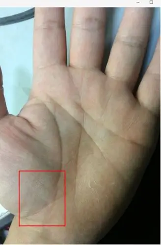 生命线末端有大岛纹,多数为男科,女科型腰痛