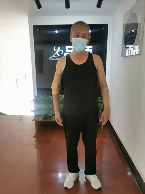 前臂假肢之美容假肢-客户案例-【官网】安装假肢,首选呼市假肢公司