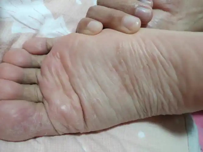 脚心长了些红点是什么情况?