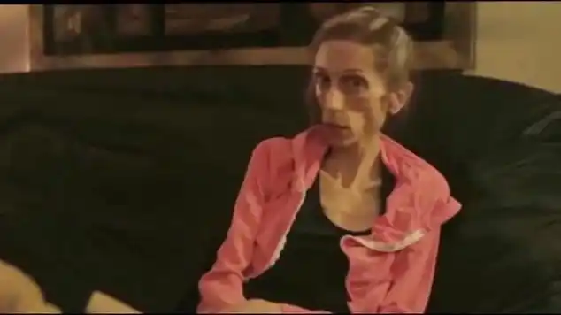 180cm美女患厌食症仅30公斤瘦得皮包骨似骷髅