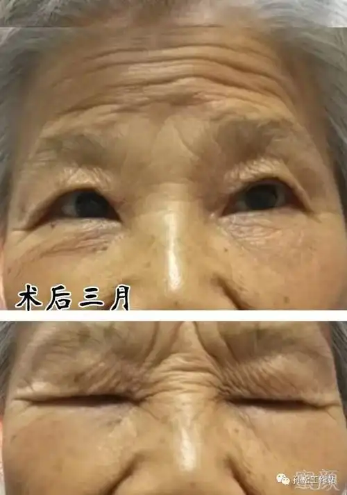 csf术式治疗老年人先天性上睑下垂