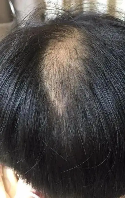 "10后"也秃了?9岁女孩不断脱发,真相竟然是拔毛癖