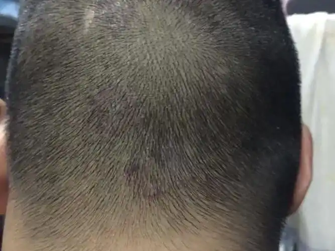 头皮总是有结痂或者一块厚重的头屑的感觉老是喜欢用手去抠是得了皮炎