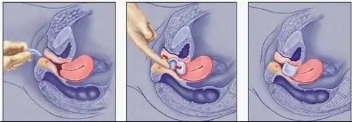 霉菌性阴道炎用什么药好