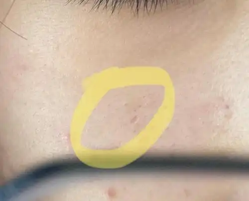 下面这里之前长了个大痘破了后毛孔这成了一个小坑还经常里面会有脏