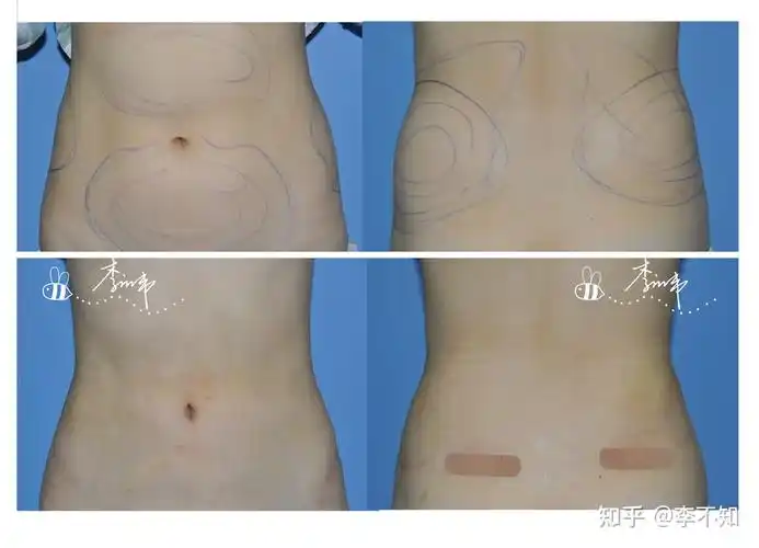 就像图中所示,抽脂前后大变样,有了腰,穿啥都好看