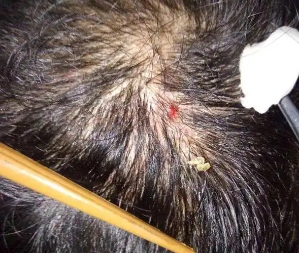 被灼伤,引起头皮炎症,毛囊炎等,这些都会影响头发营养供给,损伤发质并