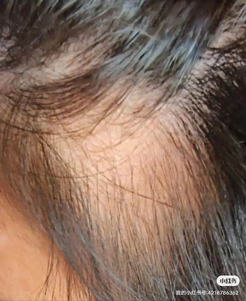 小姐姐原来额头两侧的头发光秃秃一块,头上的血淋淋的一块 - 抖音