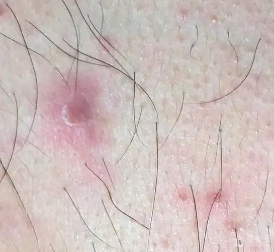 胸口上红点不痛不痒,已经有半个月之久