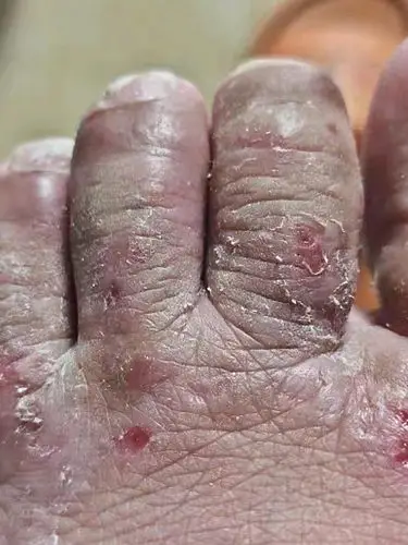 之前烂脚丫的时候又痒又疼,不知道有没有同病相怜的.