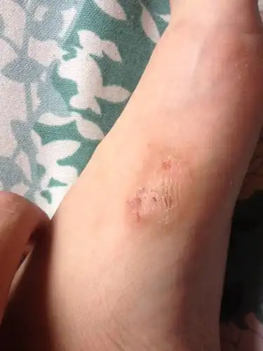 足部起藓,经常会瘙痒,抓破又很痛,持续快一年了,怎么也消不下去.