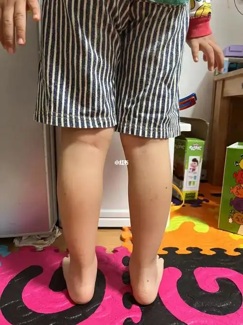 08走路不抬脚图1光脚时刻图2护正时刻#走路不抬脚 #足球  #小腿外翻