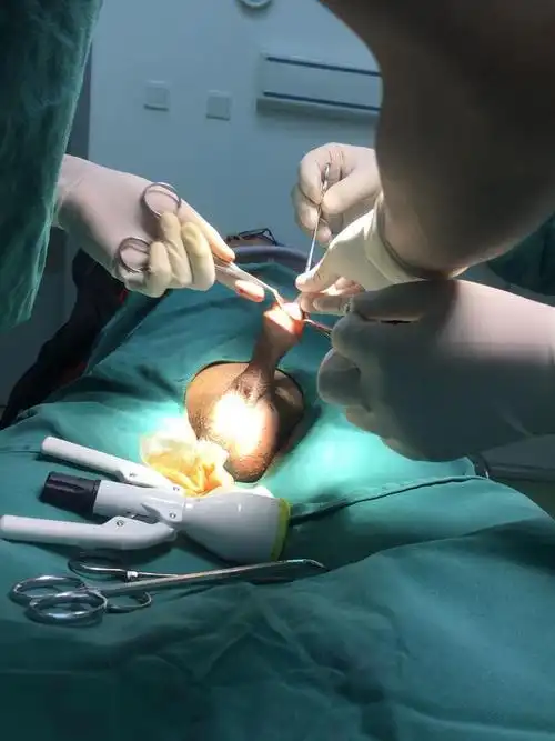 吻合器包皮环切术美观,操作方便,值得推荐,但其费用稍高,且需要取钉子