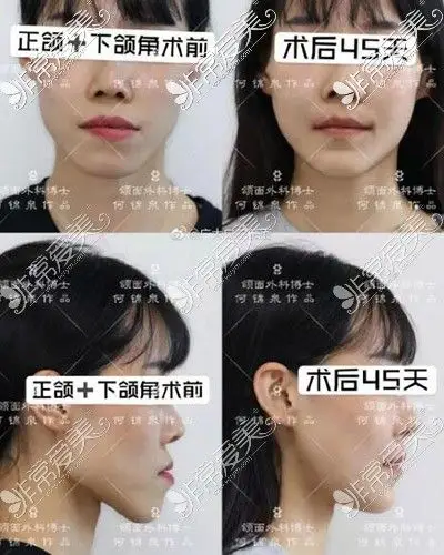 何锦泉正颌下颌角手术对比