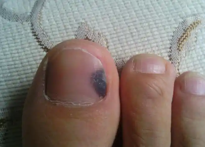 指甲变黑了是身体出了问题吗,黑指甲是否有癌变的可能?-常青藤健康网