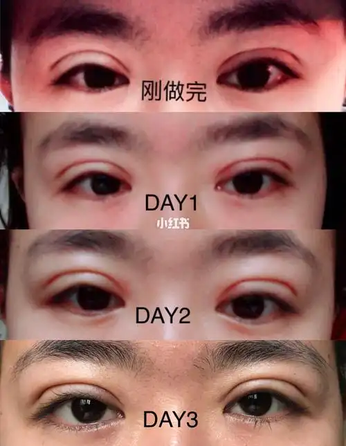 埋线三点定位双眼皮~十五天恢复过程图啦啦啦 更新! 一年之后!