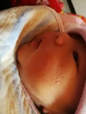 宝宝脸蛋上有白泡泡怎麼回事?