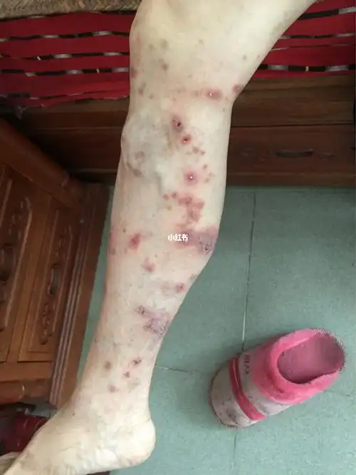 求治疗方法 本人母亲糖尿病 腿部静脉曲张加瘙痒 试过看吃药涂药膏