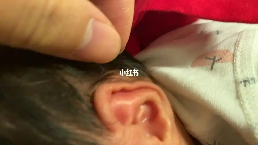 急求这算耳朵粘连吗属于什么耳呢