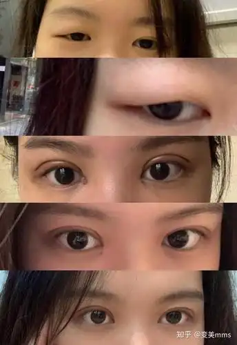 割了双眼皮后 老了一定会塌吗?