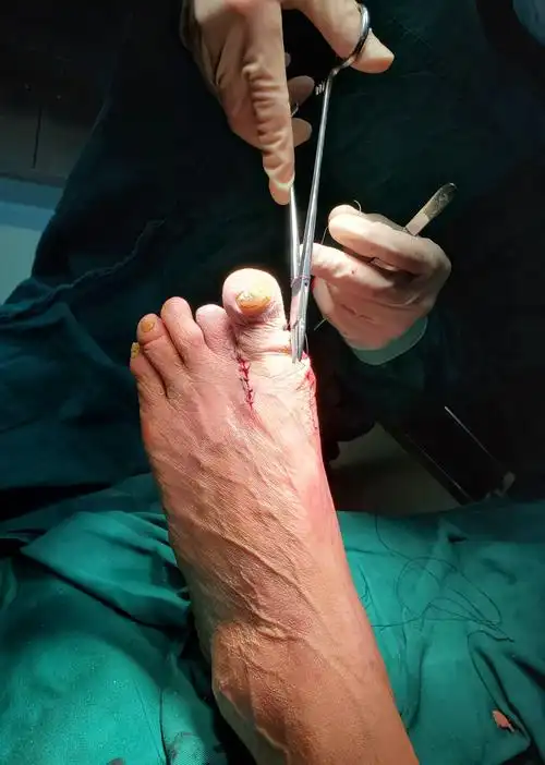 高跟鞋美女通病,拇外翻你真的了解吗?