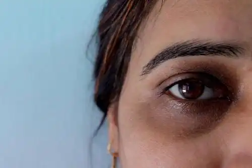 网传黑眼圈由肾虚导致?黑眼圈真的和肾虚有关系吗?