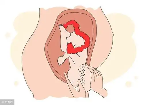 其实,胎儿入盆时间的早晚和分娩时间的早晚没有必然的联系.