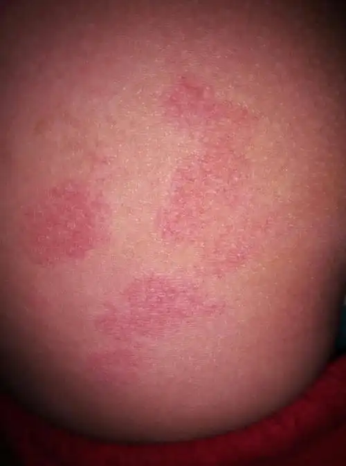 臀部起了一些红色斑点是什么