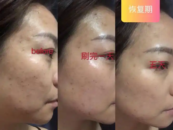 04博乐达水杨酸恢复五天的效果图来了