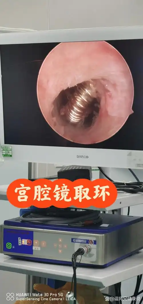 今日宫腔镜取环术