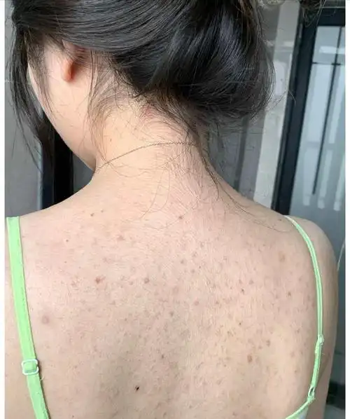 一,出油多,身上频繁起痘的