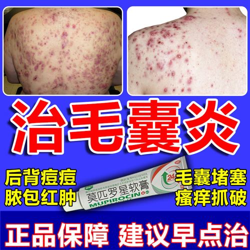 后背长痘毛囊炎瘙痒专科用药 背部除螨祛痘药膏毛囊炎药专克用药溢脂