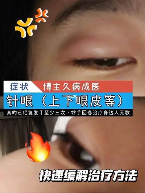 然后换另一家医院,说是针眼,叫眼球麦粒肿,然后开了