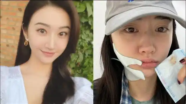 景甜晒拔智齿后素颜照,双眼皮手术痕迹明显,曾坦言十分后悔整容