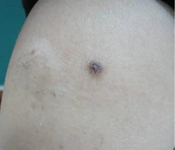 皮肤纤维瘤档案首揭秘