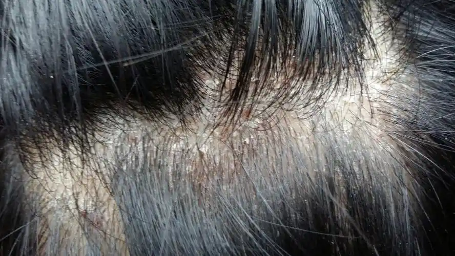 头皮成这样了,这是什么症状?