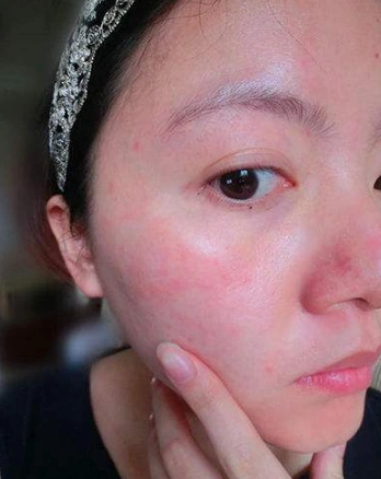 皮肤过敏图片大全 (54)