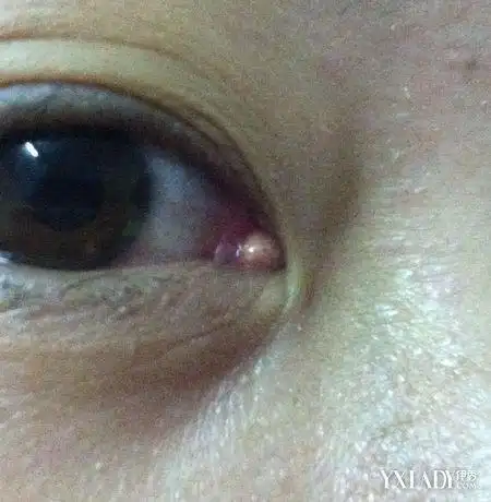 图眼角长了个小肉粒怎么办切莫大意这三种情况