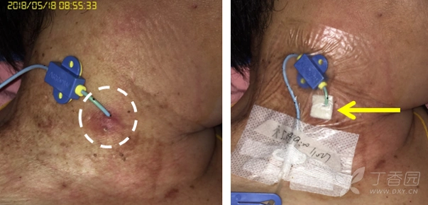 颈内静脉穿刺点感染,使用银离子敷料