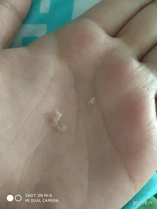 为什么抠下来大块的头皮屑会有瞬间的快感