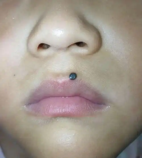 儿童色素痣手术