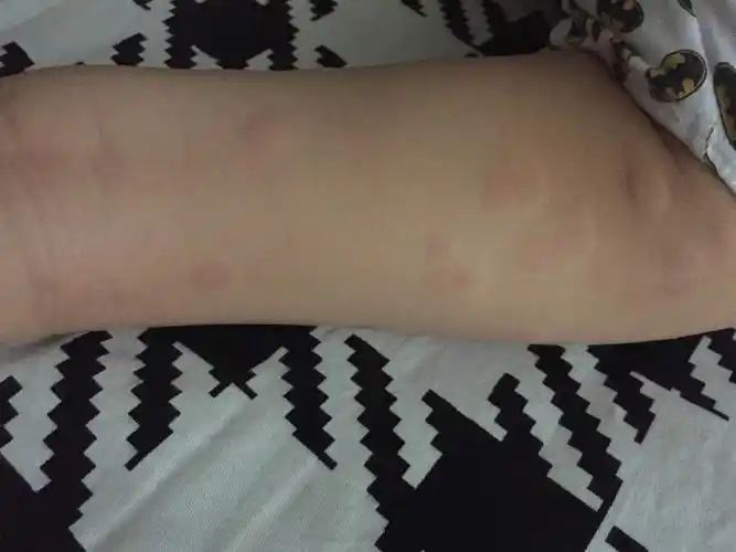 孩子出现过敏后身体上开始促发一些红疹,慢慢开始增多,伴有特别的瘙痒