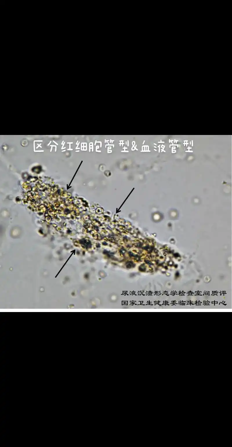 区分红细胞管型与血液管型 - 抖音