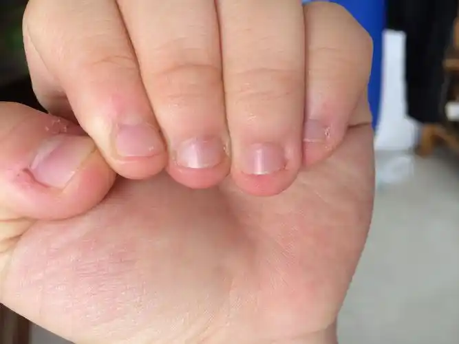 喜欢咬手指甲,求补救方法!