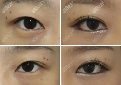 韩国这十家下眼睑下拉手术对比图片,一般多少钱齐曝光!