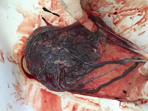 这应该是膜状胎盘吧