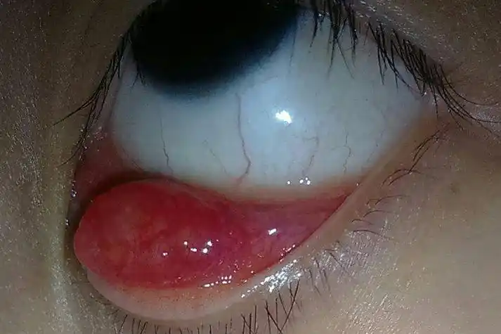 睑腺炎患者的结膜水肿图