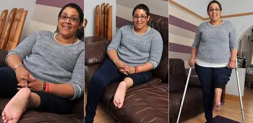 脚后跟朝前当膝盖:英女子大腿截肢反转接小腿